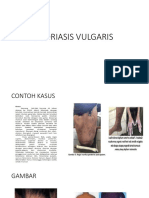 Psoriasis Vulgaris