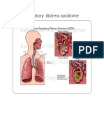 Acute Respiratory Distress Syndrome