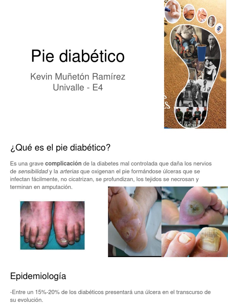 Pie Diabético Enfocado A Neuropatia PDF Diabetes mellitus Especialidades Medicas