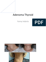 Adenoma Thyroid: Fanny Indarto