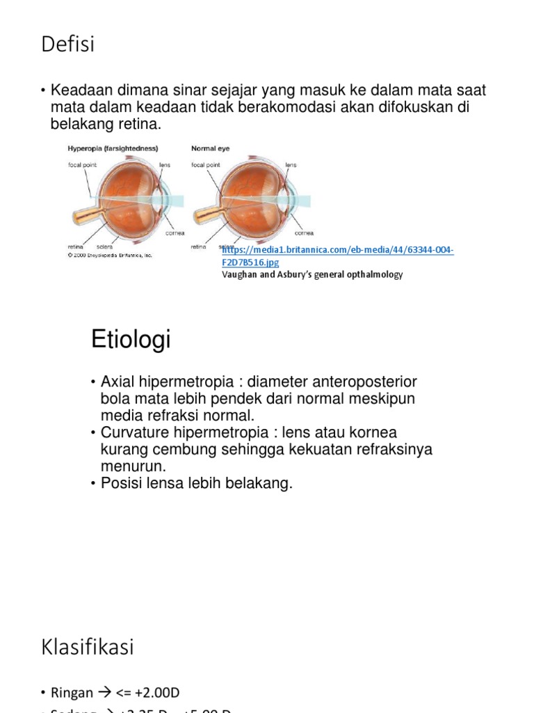 Hipermetropi | PDF