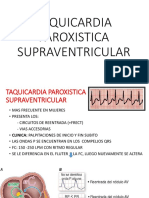 Arritmias Supraventriculares