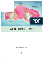 Acute-Salpingitis-PID.pdf