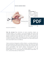 Anestesia Troncular Del Nervio Dentario Inferior