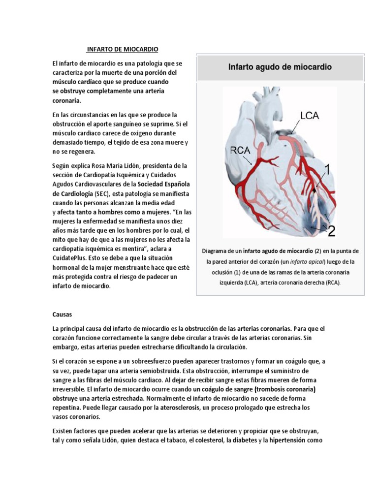 Infarto de Miocardio | PDF | Infarto de miocardio | Angiología
