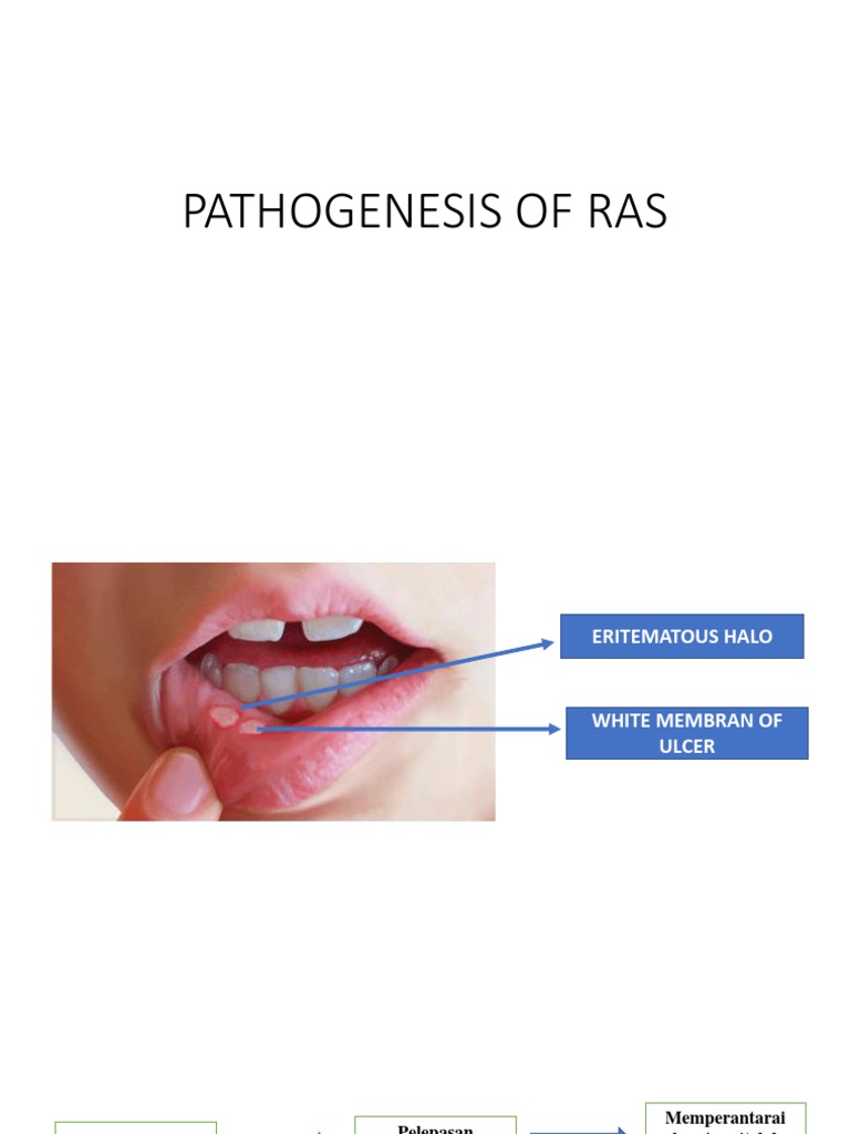 Pathogenesis of Ras