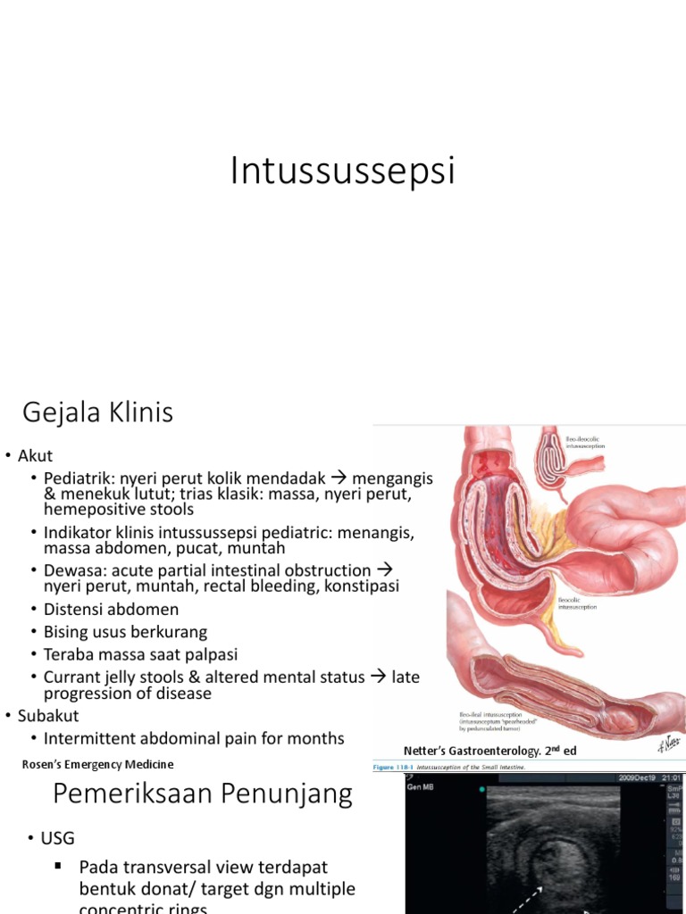 Intususepsi | PDF | Kesehatan Holistik | Sains & Matematika