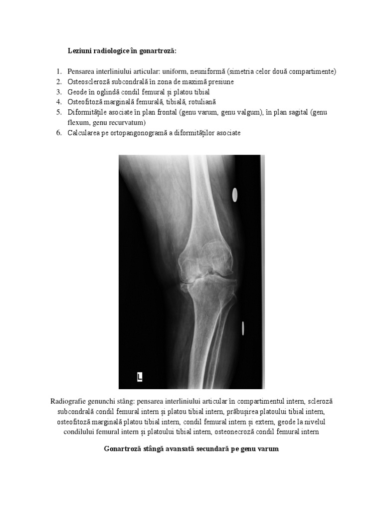 tratamentul sclerozei subcondrale a genunchiului blocarea durerii de cot