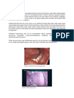 White Sponge Nevus