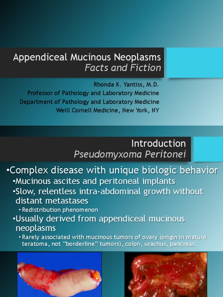 Appendiceal Mucinous Neoplasm Overview | PDF | Neoplasms | Medical ...