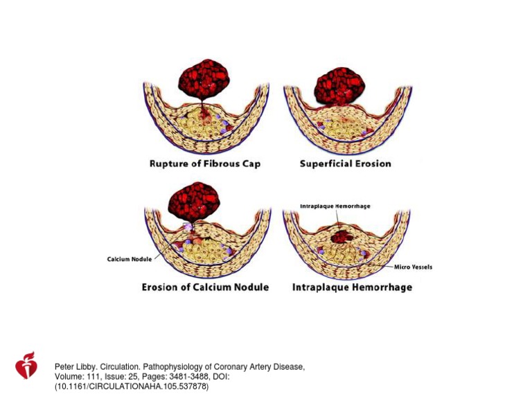 Pathophysiology of Coronary Artery Disease | PDF