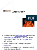 Anencephaly.pptx