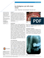 Aggressive Dentigerous Cyst With Ectopiccentral Incisor