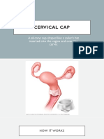 Cervical Cap: A Silicone Cup Shaped Like A Sailor's Hat Inserted Into The Vagina and Over The Cervix