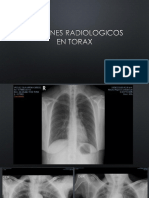 Practica Patrones Alveolar e Intersticial