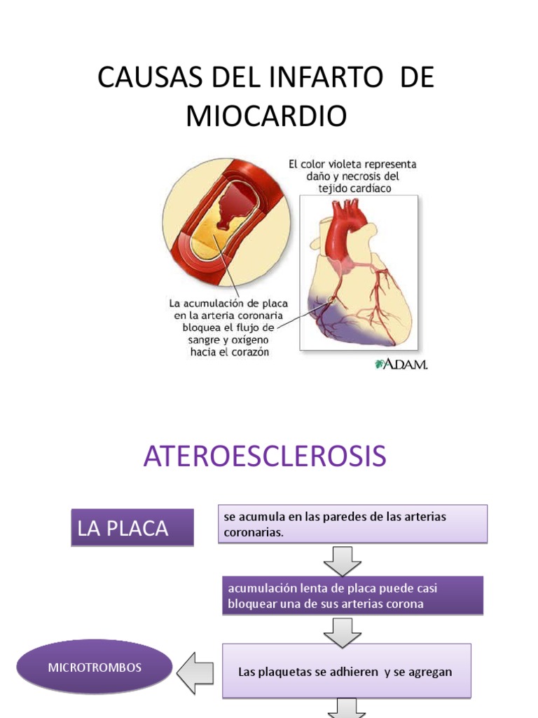 Causas y Consecuencias Del Infarto de Miocardio | PDF | Infarto de ...