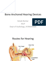 Bone Anchored Hearing Devices: Ketaki Borkar Aslp Dept of Audiology, AYJNISHD (D)