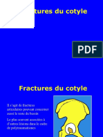 04 - Fractures Du Cotyle
