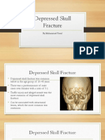 Depressed Skull Fracture