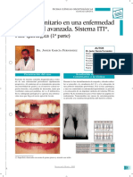 implante periodontitis avanzada