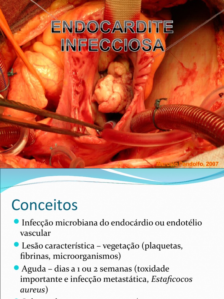Endocardite Infecciosa Por Marcelo Pandolfo Instuição Santa | PDF ...