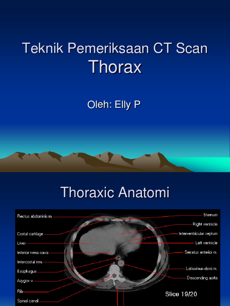 Teknik CT Scan Thorax dan Anatomi | PDF | Ct Scan | Lung