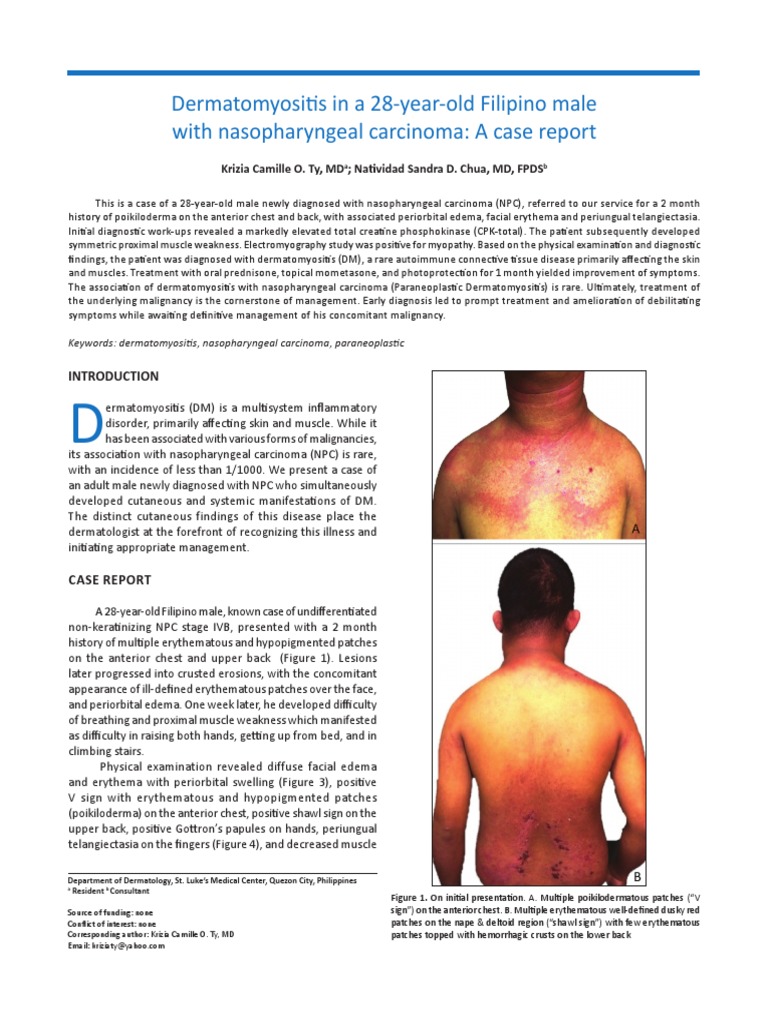 Case Report of Dermatomyositis | PDF | Epidemiology | Health Sciences