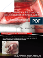 Alveoloplastia y Regulacion de Los Rebordes Alveolares