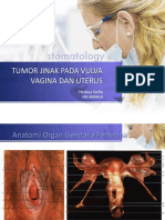 Tumor Jinak Pada Uterus Dan Vagina