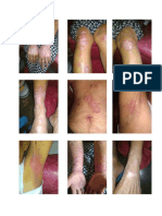 psoriasis.pdf