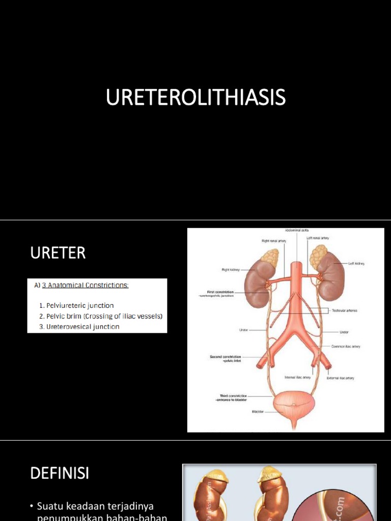 URETEROLITHIASIS | Download Free PDF | Urology | Medical Specialties