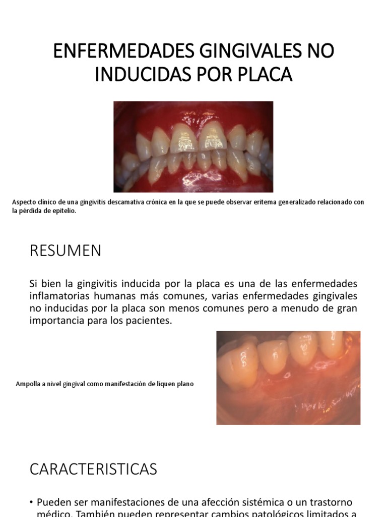 Enfermedades Gingivales No Inducidas Por Placa | PDF | Linfoma | Virus