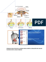 ESTADIOS EVOLUTIVO DE LA HERNIA DISCAL SEGÚN LA RELACIÓN DEL NUCLEO PULPOSO CON EL ANILLO FIBROSO.odt