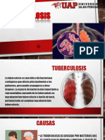 Tuberculosis