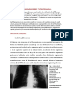 Patrones Radiológicos en TB Posprimaria