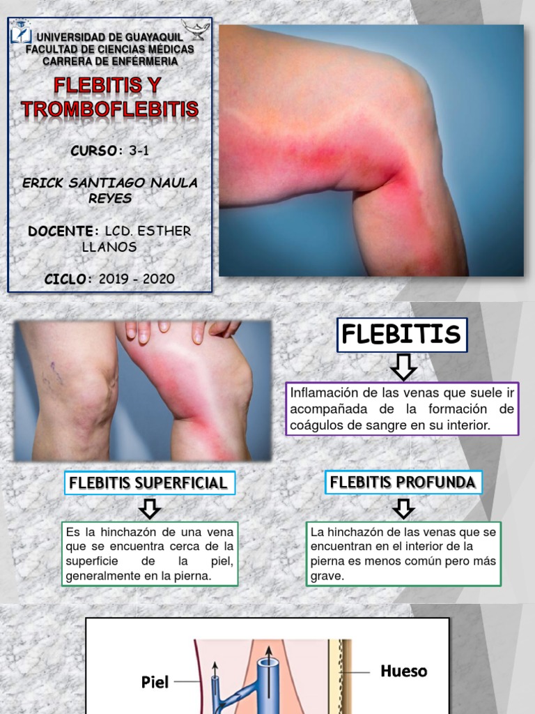 Flebitis y Tromboflebitis: Guía Completa | PDF | Venas varicosas ...