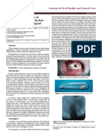 Delayed Replantation of Maxillary Left Central Incisor After 17hours: Case Report