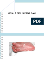 Gejala Sifilis Pada Bayi