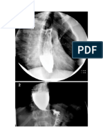 Achalasia Cardia