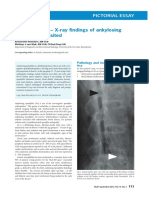 Bamboo Spine - X-Ray Findings of Ankylosing Spondylitis Revisited