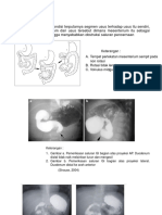 Volvulus