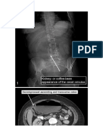 Cecal Volvulus