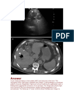 Acute Enfhisematosus Colecistitys