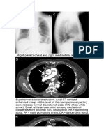 Cava Syndrome Altough B-cell Lymphoma