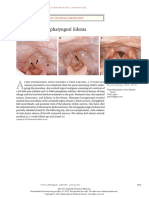 Laryngopharyngeal Edema: Images in Clinical Medicine