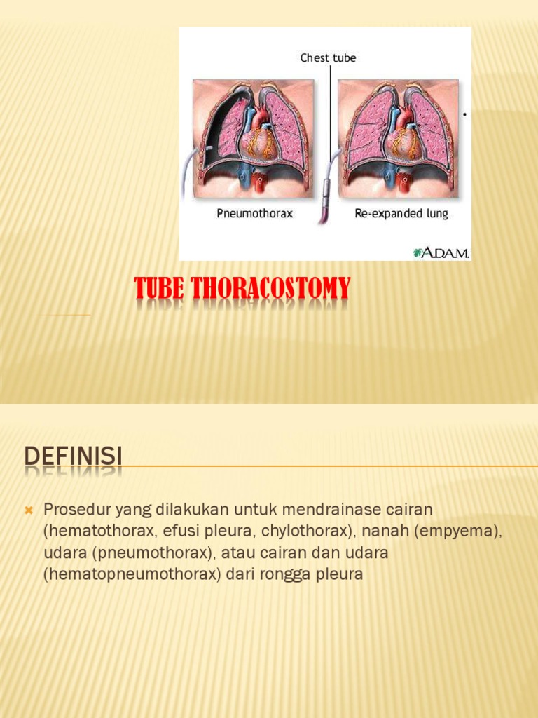 Chest Tube Thoracostomy | PDF