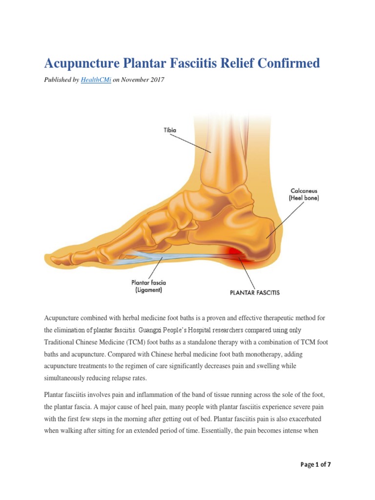 Acupuncture Plantar Fasciitis Relief Confirmed PDF Acupuncture Traditional Chinese Medicine