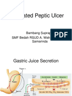 Treating Perforated Peptic Ulcer