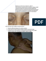 Circumscribed fluid-filled lesions and diabetic skin findings