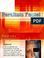 paralisis facial